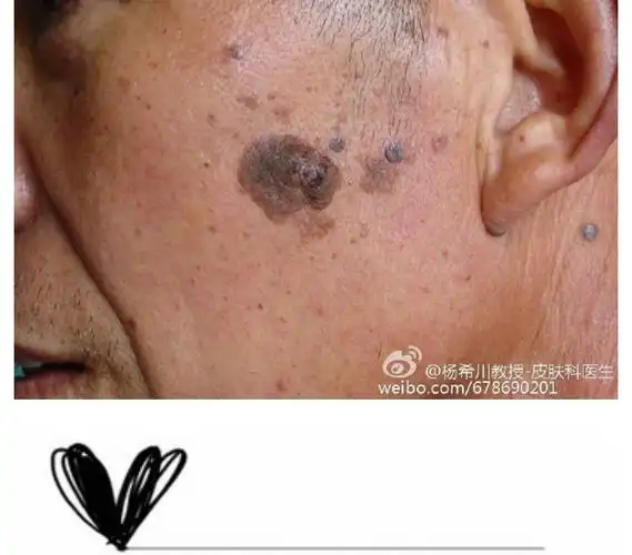 脸上黑斑不用怕