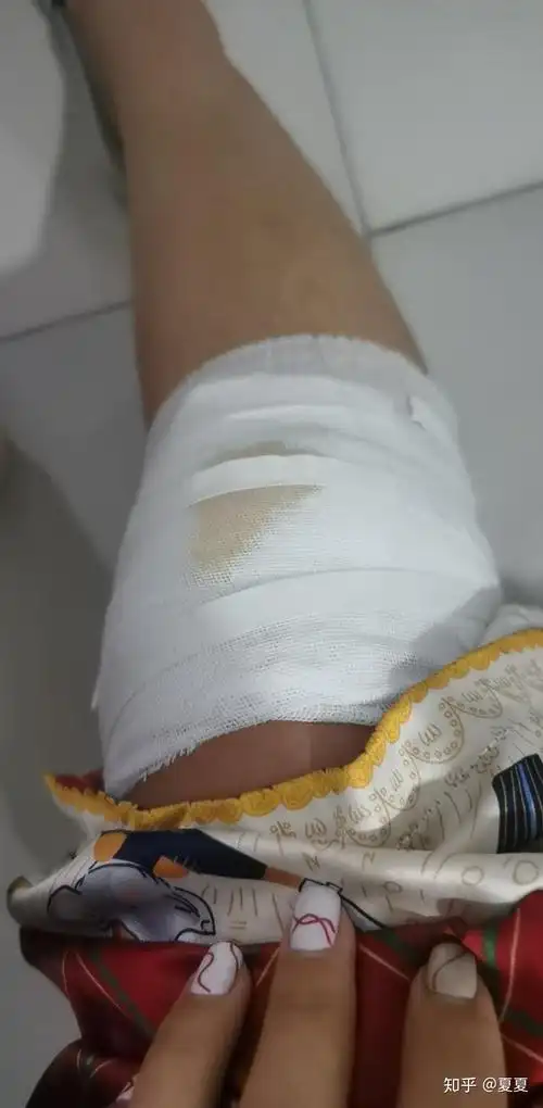 膝盖摔伤,抹了碘伏结痂后如何防止留疤? - 知乎