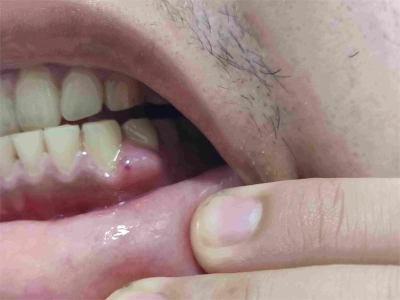 边缘性龈炎的症状和图片 - 有来医生