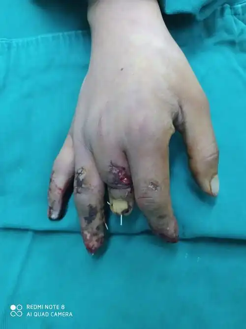 两例严重手外伤治疗的收获和遗憾