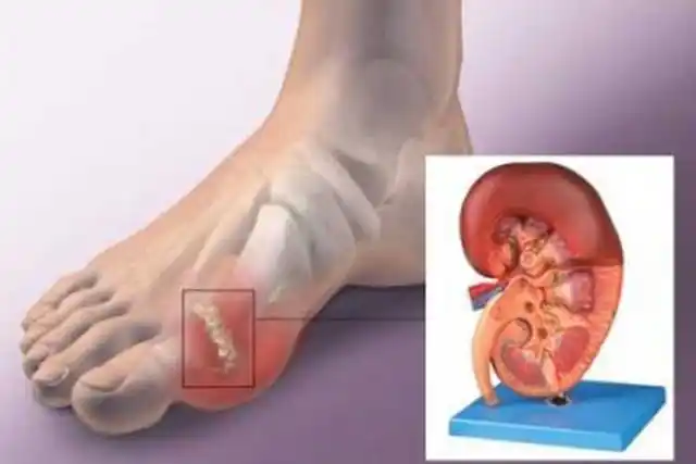 痛风病总是盯住年轻人原因有3治疗痛风日常护理注意三点