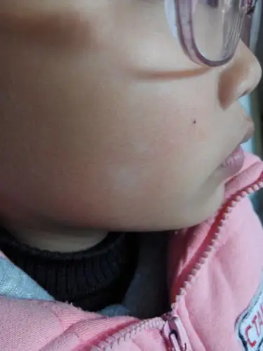 小女孩脸上这白斑是什么啊是白癜风吗请各位老师帮忙看下谢谢