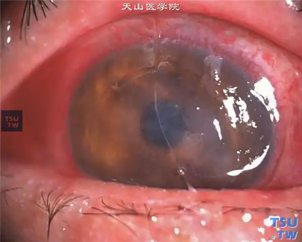 细菌性角膜炎(最详症状图解)