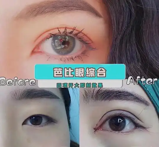 芭比眼综合 

全方位放大双眼