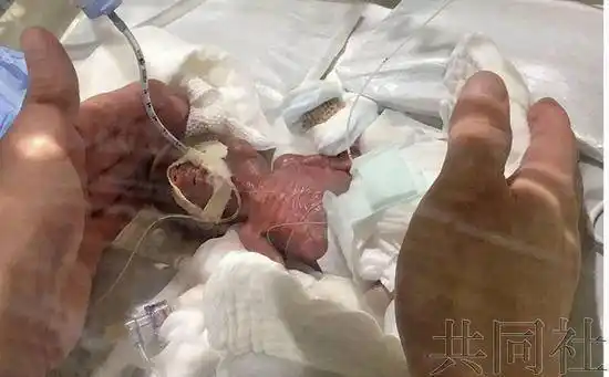 世界最小男婴出院 出生仅重268克 如今体重3238克-第1张图片-趣闻屋
