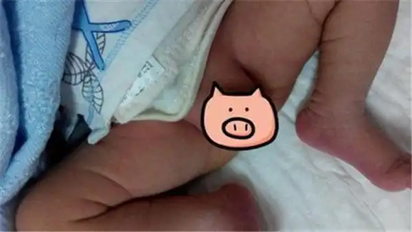 8个月小鸡鸡就截肢了医生说出后妈害人真相家人悔恨不已