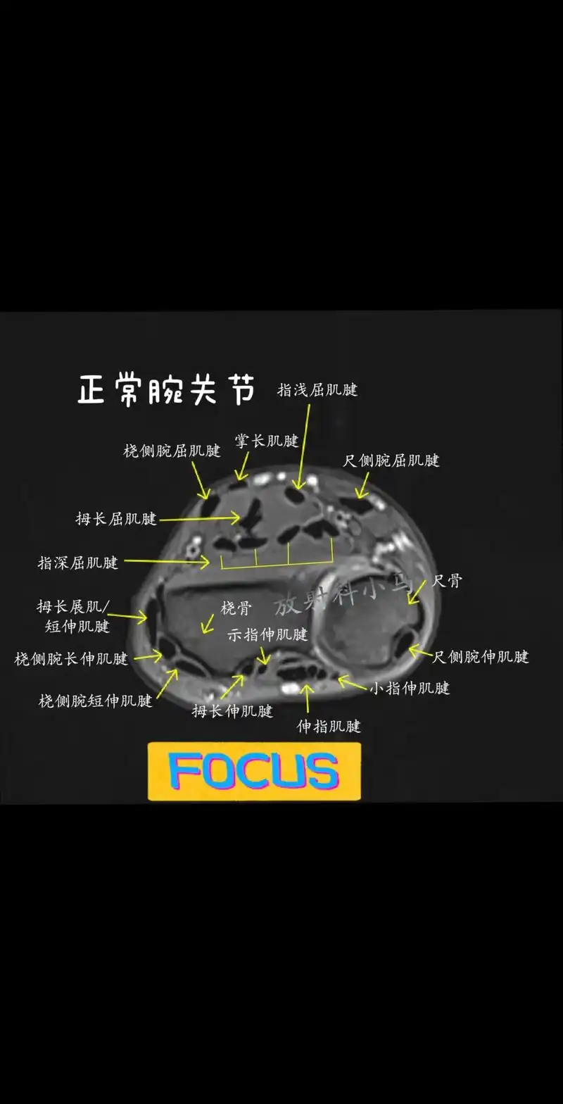 正常腕关节结构 - 抖音