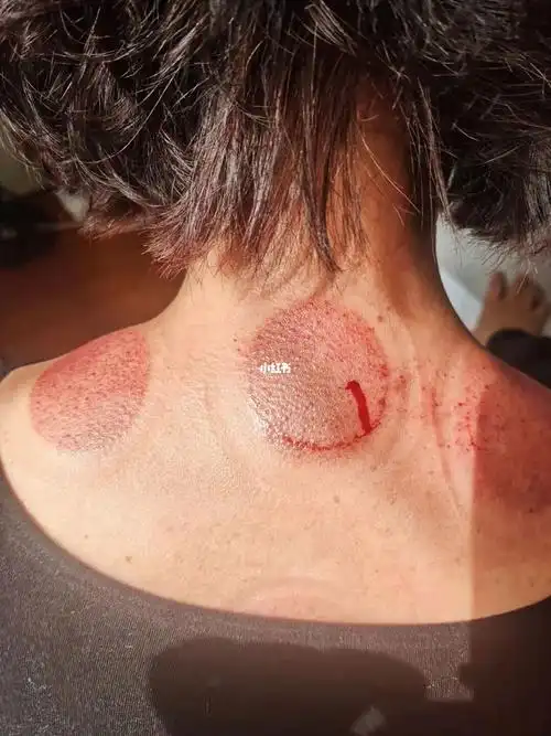 头晕肩颈疼痛 可能是你的肩颈堵了哦