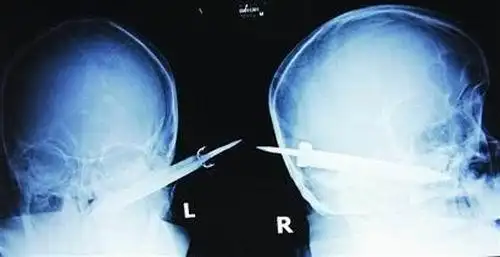 男子头插三棱刀求医 刃长10厘米只露刀柄(组图)