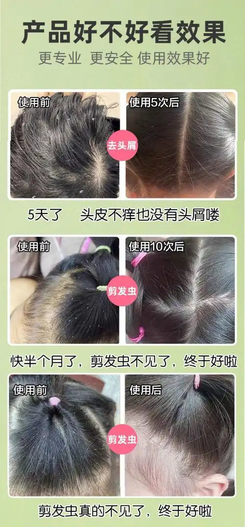 315岁中大童儿童除螨洗发水剪发虫头皮痒去屑除螨虫止痒洗发露1瓶洗发
