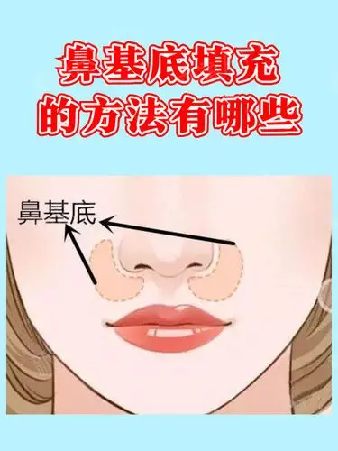 鼻基底填充的方法有哪些