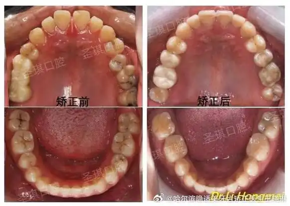 圣琪口腔王晓琳团队正畸案例##牙齿矫正##开颌