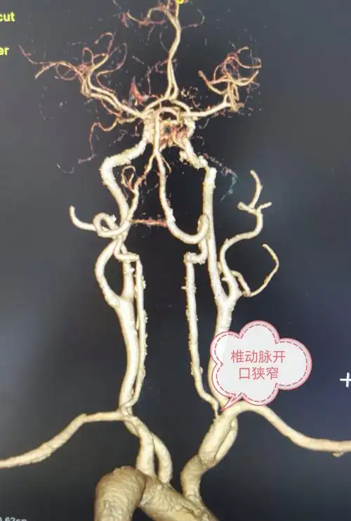 头晕记得要明确一下是否有椎动脉狭窄_椎动脉狭窄_椎动脉狭窄症状表现