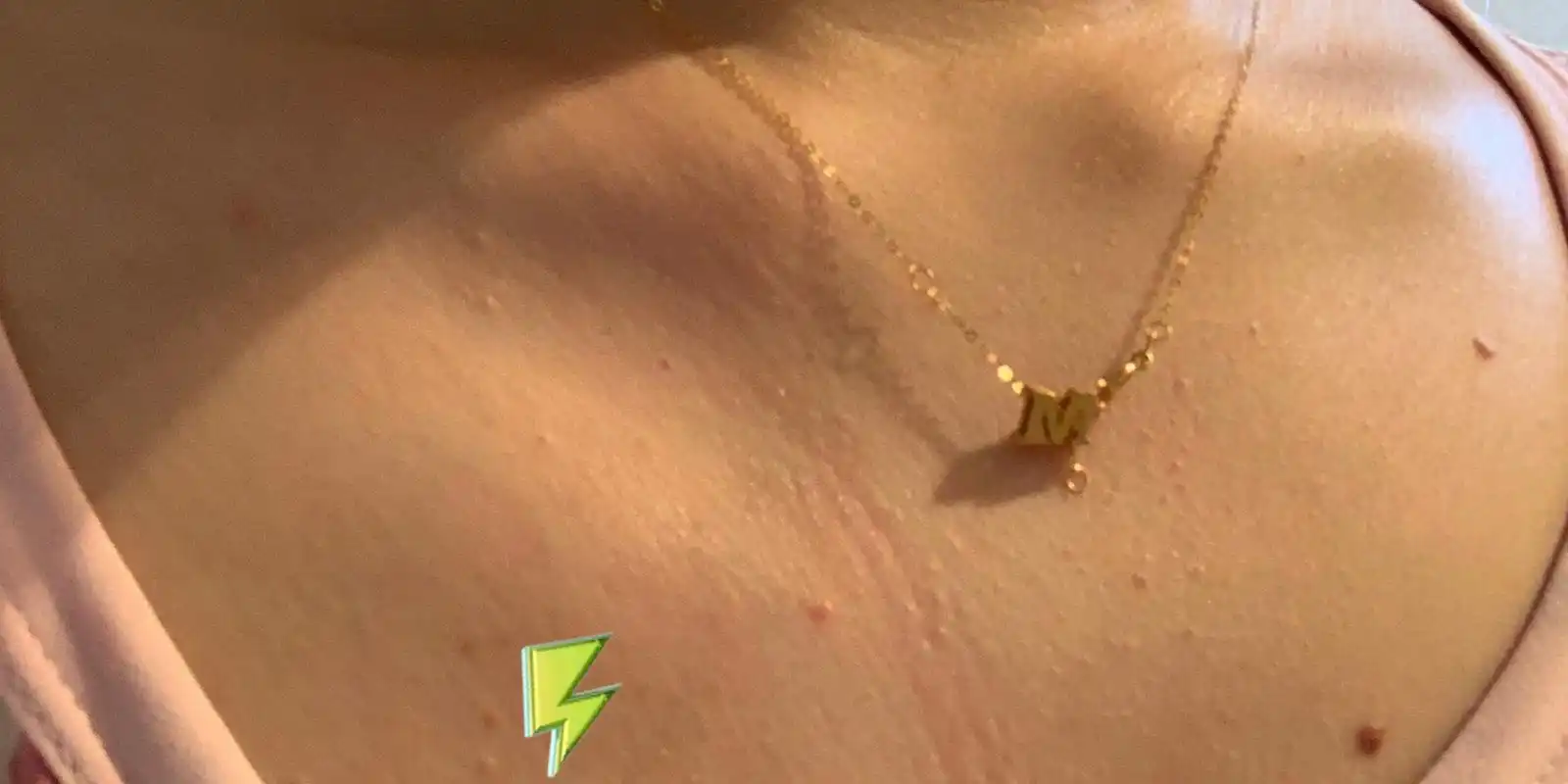 右侧锁骨下方突然就鼓出来了 有没有人也这样右侧锁骨下方突出的,好慌