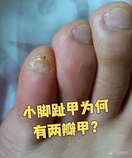 如果小脚趾受过伤,比如走路时踢到东西或被重物砸到,可能会导致指
