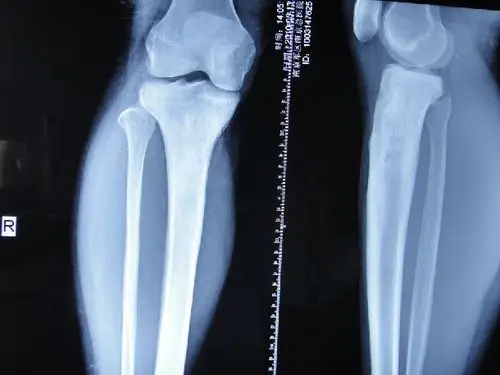 慢性骨髓炎的症状与诊断科普