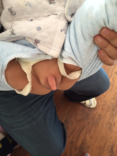 儿子的小鸡鸡肿了