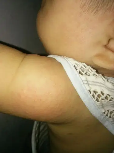 宝宝身上出的是痱子吗.该怎么办一大片啊