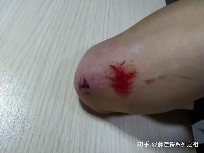 你们学滑板和轮滑时用了多长时间你摔了多少次惨吗