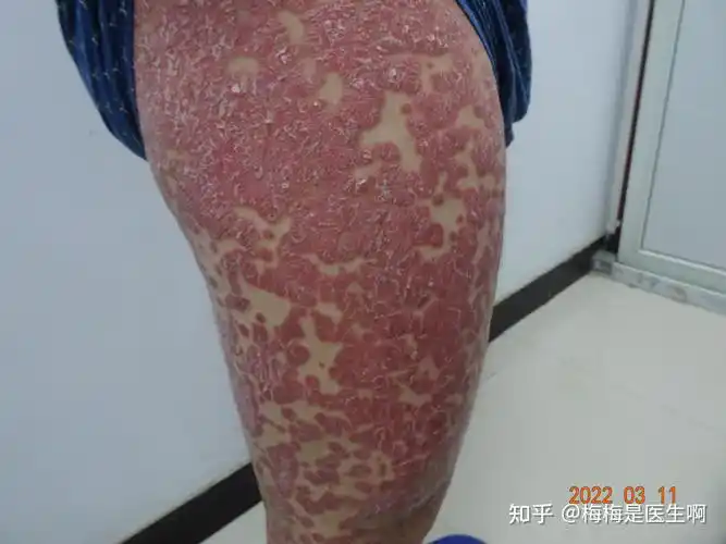一个男孩出国旅游后皮肤变化让护士倒吸一口冷气全身银屑病激素药密集