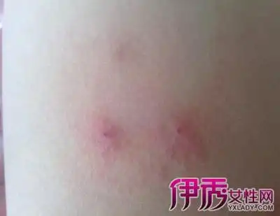 【图】男性淋病早期症状图 3个治疗原则你遵守了吗