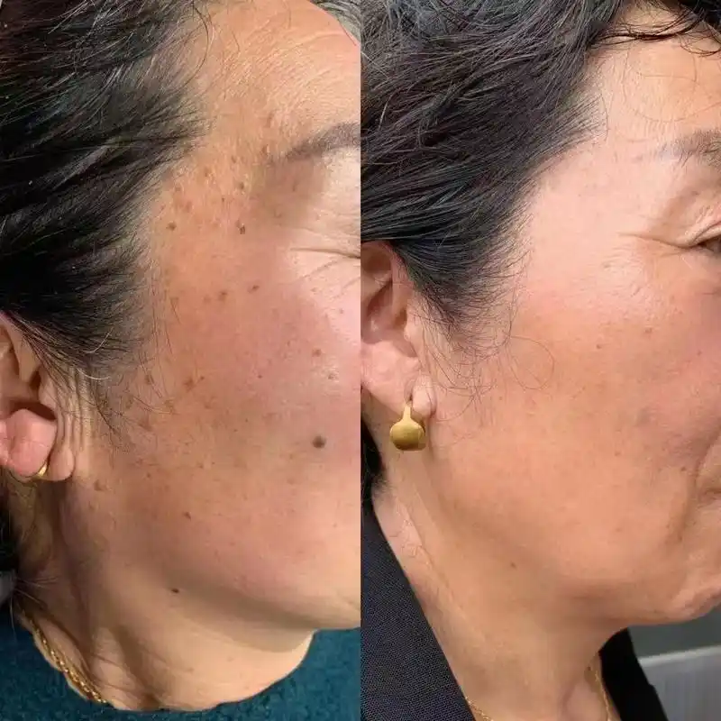 脸部扁平疣去除前后对比一次清除干净