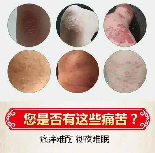 专营百藓夏塔热片紫椒癣酊股体藓癣止痒膏私处爱慈痒疹膏