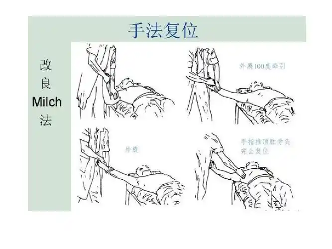 肩关节脱位手法复位ppt