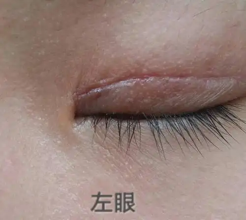 割双眼皮拆了线10天了,请问这是疤痕增生吗?