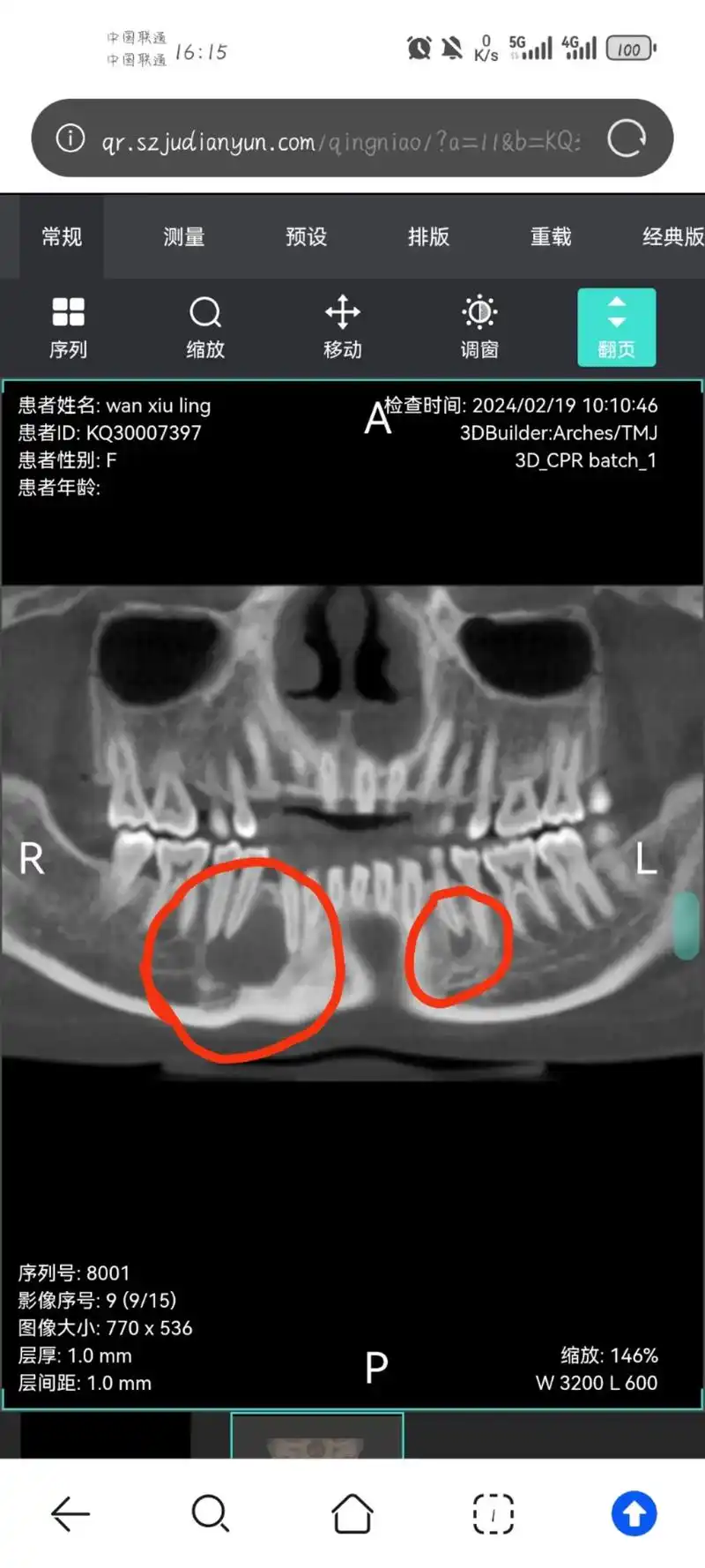 原本去拍ct拔智齿的,结果发现两个根尖囊肿,好像要手术,牙齿 - 抖音