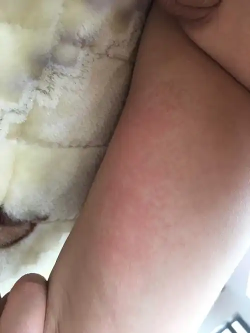 宝宝大腿内侧大片发红是怎么回事?