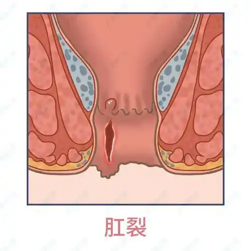 拉屎菊花痛,可能真错怪了痔疮!3种情况,教你辨别处理_肛门_症状_时候