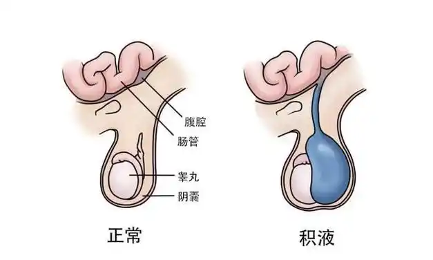 宝宝蛋蛋明显肿大小心是鞘膜积液
