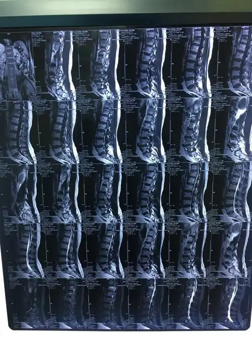 胸椎压缩性骨折