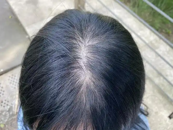 姐妹们来看看我这发缝算秃吗