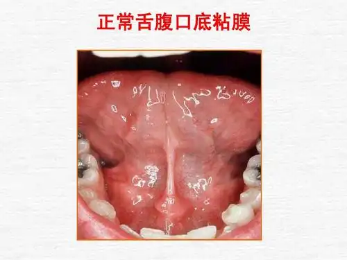 正常舌腹口底粘膜