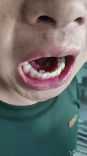 求助牙龈上这个东西是啥