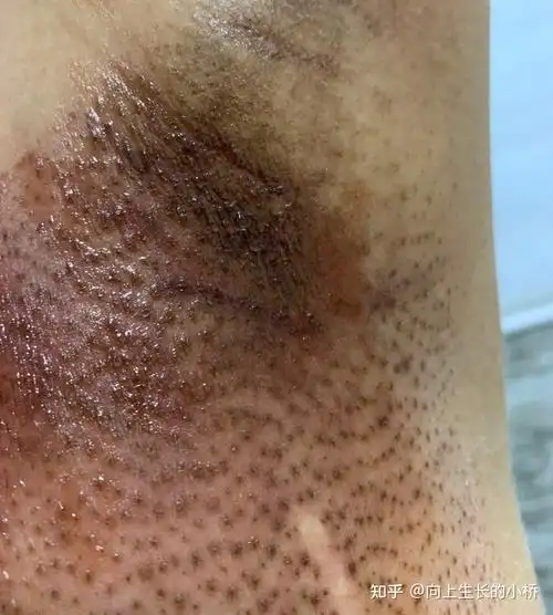 我的抗癌日记放疗篇