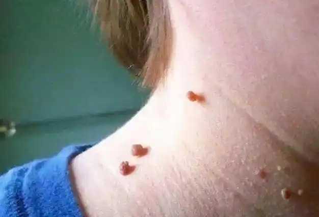 男人身上长有这种疙瘩越抠越多不要怀疑是感染hpv了