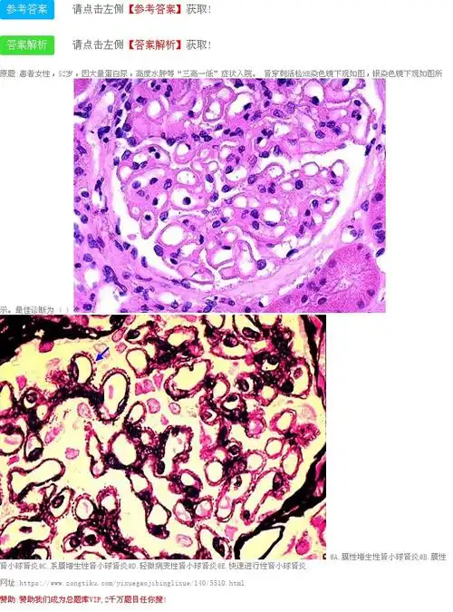 肾穿刺活检he染色镜下观如图,银染色镜下观如图所示.最佳诊断为 ( )