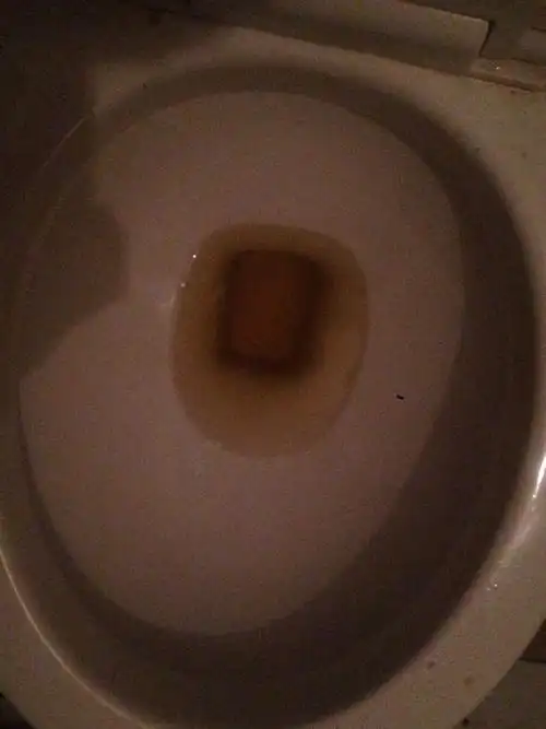 这颜色的尿是酱油尿吗.如果是是怎么有的.