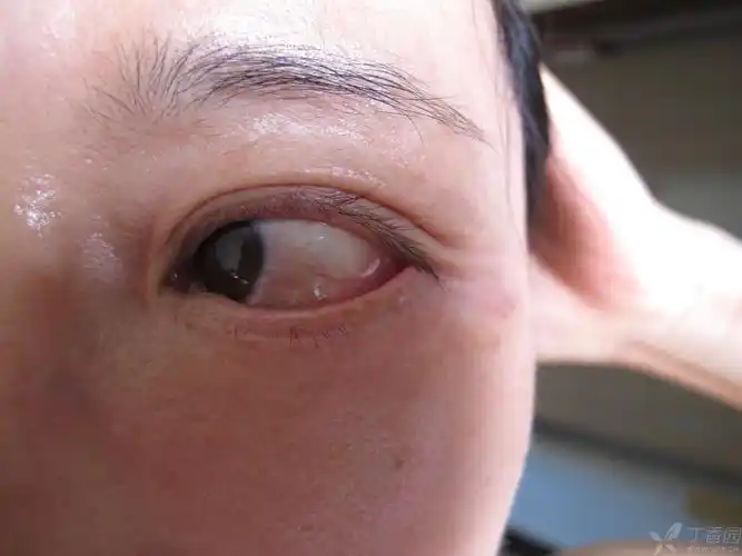 【眼表疾病讨论】不明原因结膜水肿