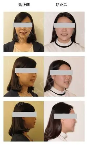 矫正前后面像对比