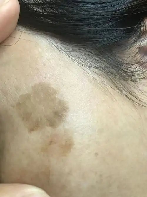 这是什么斑# 黑色素通过受损的基底膜进入. 来自紫予皮肤记 - 尾