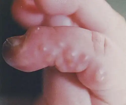 14种湿疹和皮炎类的儿童皮肤病图片及临床特征和鉴别诊断 [病例帖]