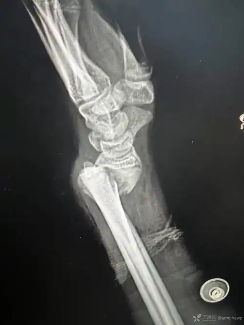 桡骨远端骨折史密斯