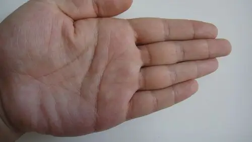 请问一下,手掌上有一些红的,白色的小点小点的,这是什么毛病了?