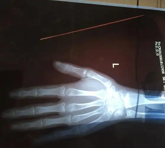 我十五岁,看了三个医生,两个说还能长,一个说骨骺线闭合了,谁能看看