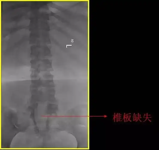 小儿先天性脊柱裂的临床诊治