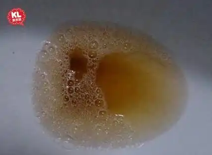 这3个地方发黄肝有病,天天吃2样东西,肝就会恢复健康!